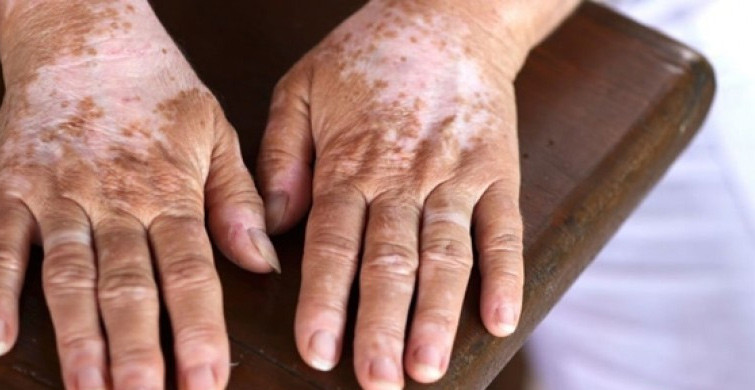 Fludrokortizon Nedir?