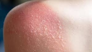 Güneş Yanığı Nedir? Evde İlk Yardım ve Tedavi Önerileri