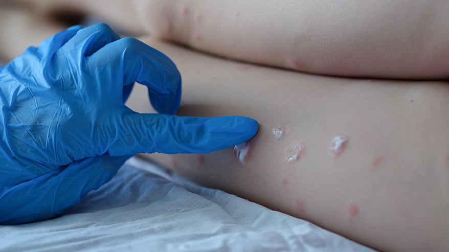 maymun çiçeği belirtileri